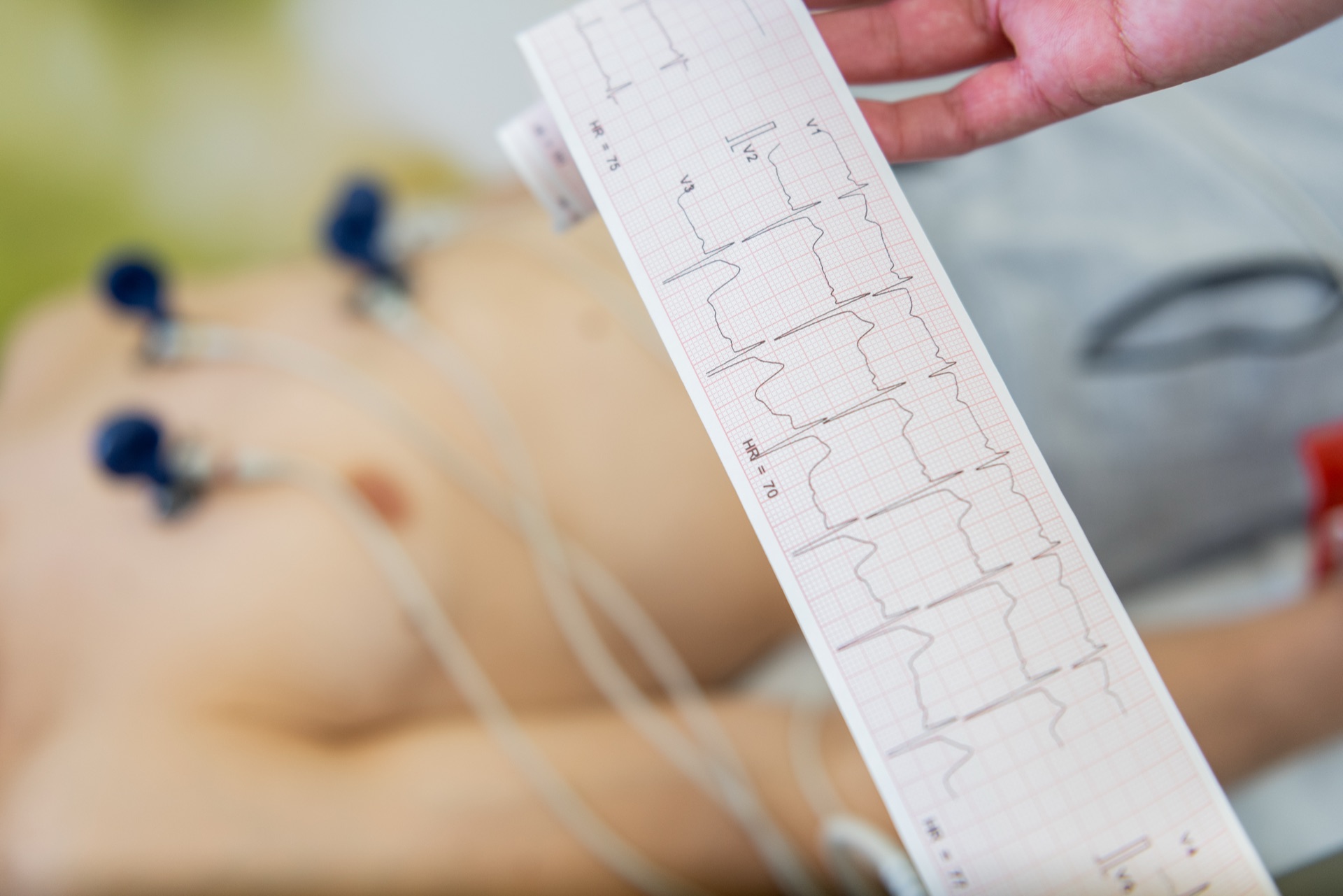 A printed ECG trace held up beside a patient wired to 12-lead electrodes